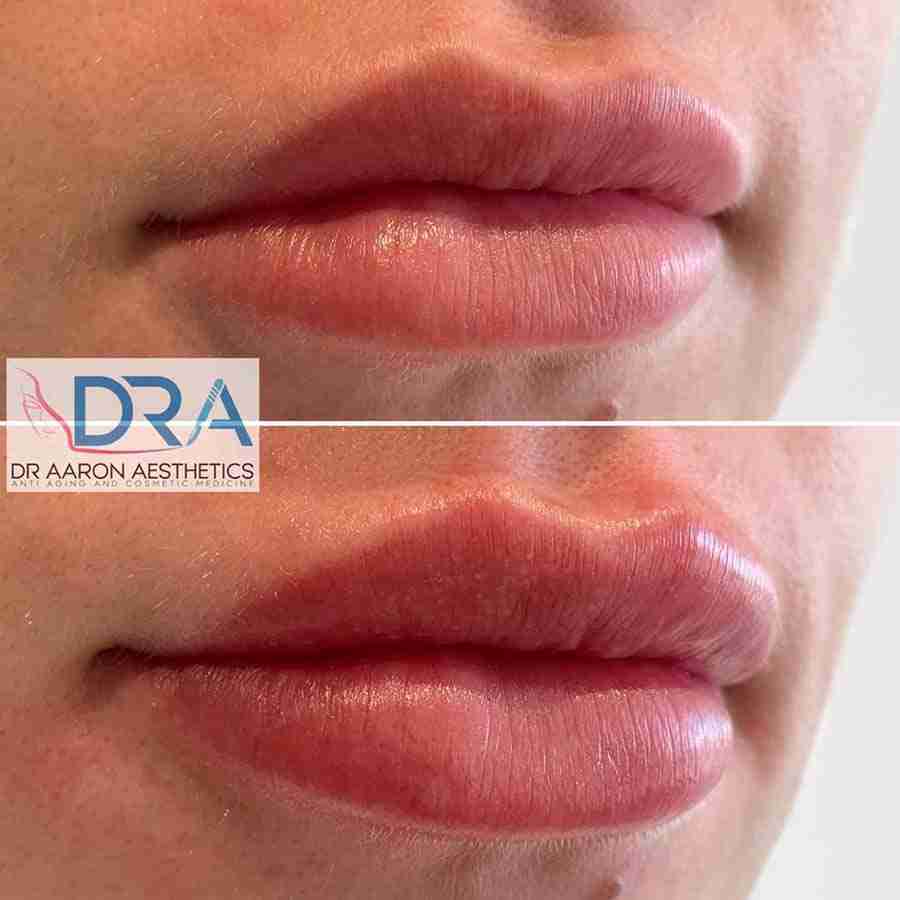 Lip Fillers Sydney, Lip Fillers Sydney, Dr. Aaron Stanes | Anti Ageing and Cosmetic Medicine Sydney