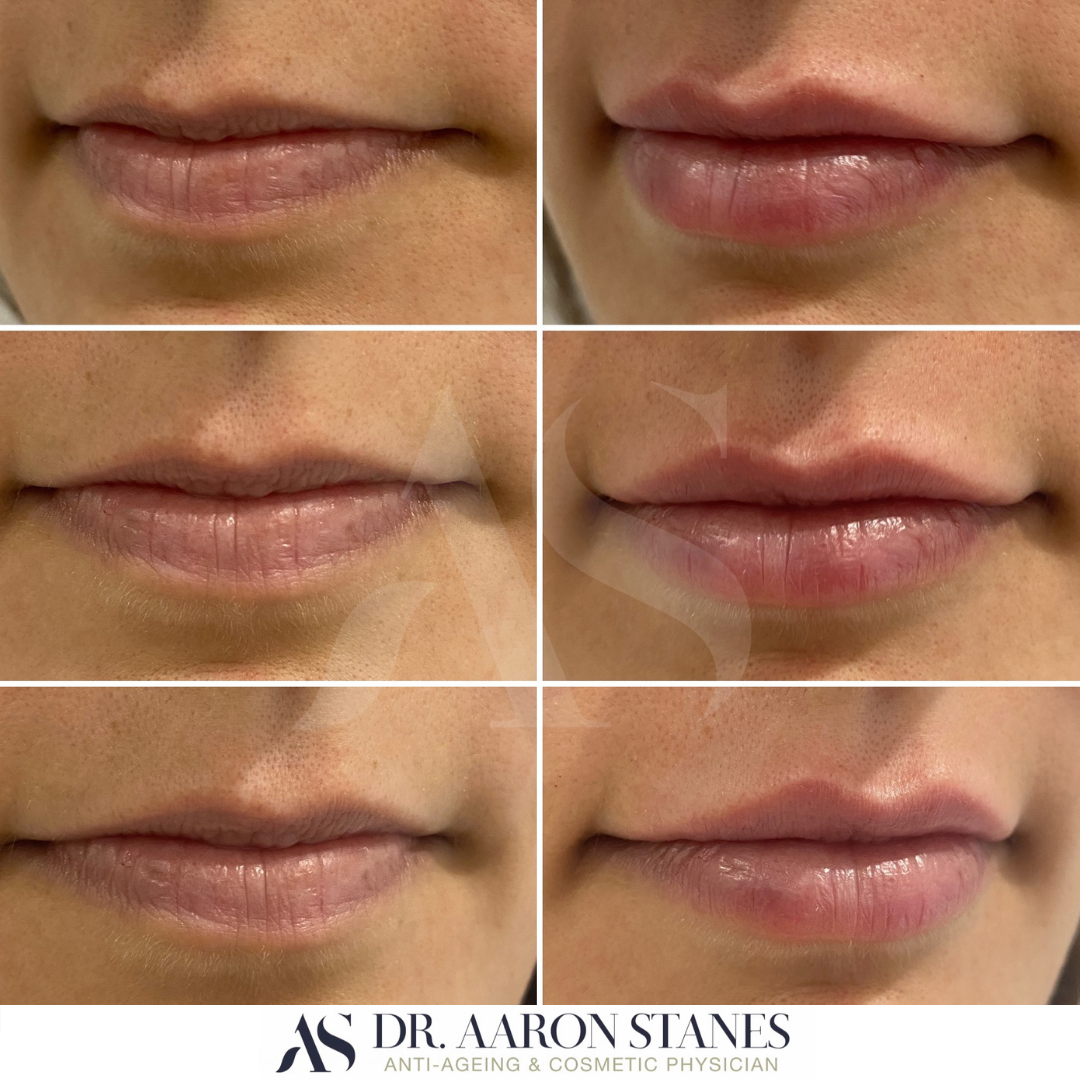 Lip Fillers Sydney, Lip Fillers Sydney, Dr. Aaron Stanes | Anti Ageing and Cosmetic Medicine Sydney